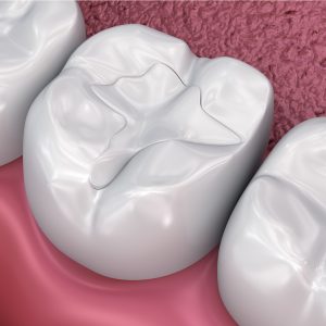 tooth-colored fillings